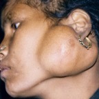 Parotid tumour, young woman