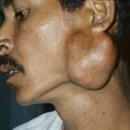 Parotid tumour,2