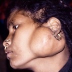 Parotid tumour,3
