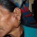 Parotid tumour