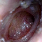 Perforation, large, R ear drum, Eustachian tube entrance visible