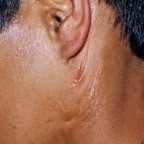 Salivary fistulae, from L parotid, ? secondary to infection or congenital