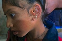 Accessory auricles