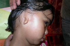 Atresia and microtia