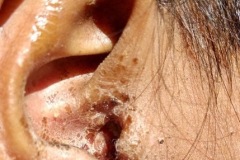 CSOM, dried chronic ear discharge from R ear