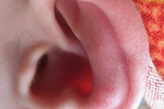 Chilblain R pinna, cold then heat exposure, recurrent, and on feet, 10y M