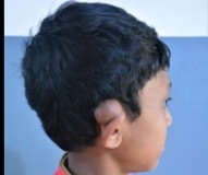 Dermoid Cyst behind ear
