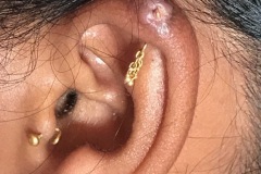 Gold stud under skin of helix, R ear