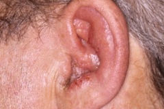 Herpes Zoster, blisters, L pinna, Ramsay-Hunt syndrome