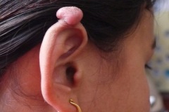 Keloid scar on helix of pinna