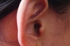 Keloid, on helix R ear