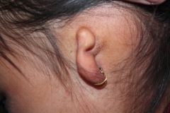 Microtia and canal atresia