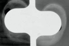 Calcification of pinna cartilage, cold exposure