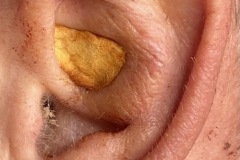 Protruding ear, 2/52 after revision pinnaplasty, increasing antihelical fold