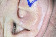Protruding ear, had pinnaplasty as child, lacks adequate antihelical fold
