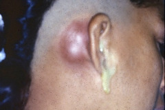 Postaural-abscess