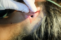 Postaural fistula 2