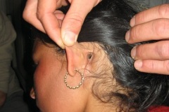 Postaural fistula