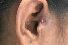 Infected preauricular sinus3