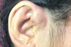 Pre-auricular sinus abscess, 30y F, R ear, acute pain, fluctuant, first episode