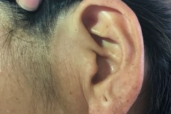 Pre-auricular sinus, 30y F, L ear, no symptoms this side