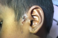 Pre-auricular sinus, chronic infection