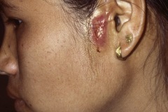 Preauricular sinus abscess, sinus pit seen at root of helix, abscess and discharge seen anterior to tragus, Lear, young girl