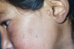 Preauricular sinus, abscess scar, L ear