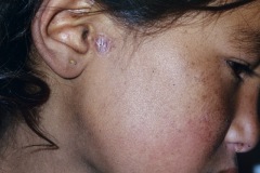 Preauricular sinus, abscess scar, R ear