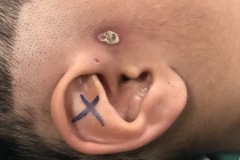 Preauricular sinus, recent and recurring infection, for surgery,R ear, young boy