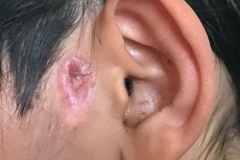 Preauricular sinus, recurrent infection, 8y girl