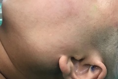 Parotid, pleomrophic adenoma, superficial and deep lobes, 26y F, slow growth x 4 years
