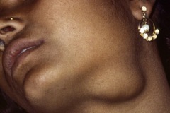 Submandibular gland tumour, young woman