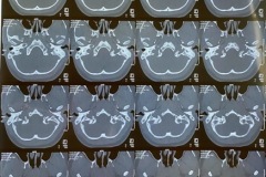 Bilateral extensive mastod erosion by cholesteatom, young girl, no previous surgery, axial CT 2