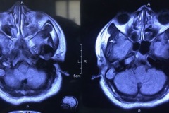 Large cholesteatoma, left mastoid, exposing posterior fossa dura, 34y F, Axial MRI scan, c