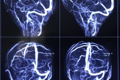 Large cholesteatoma, left mastoid, exposing posterior fossa dura, 34y F, vascular MRI scan, left lateral sinus occluded, e