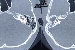 Lateral scc fistula, cholesteatoma, CHL, 27y male, Axial CT