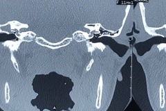 Lateral scc fistula, cholesteatoma, CHL, 27y male, Coronal CT