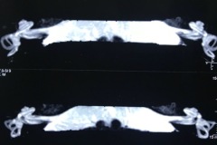 MRI scans of inner ears, normal 1