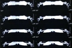 MRI scans of inner ears, normal 2