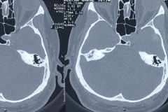 Sigmoid sinus, high anterior variant, cholesteatoma, 3