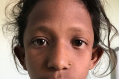 Treacher-Collins syndrome, bilateral atelectasis of ear drums