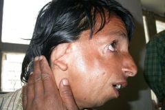 Treacher-Collins syndrome, bilteral meatal atresia, microtia, maxillary hypoplasia