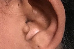 Treacher-Collins syndrome, with preauricular sinus, girl