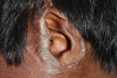 Burn scarring