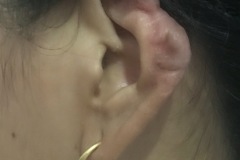 Hypertrophic scar/keloid after trauma, L ear, 25y female