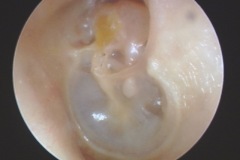 Auto-atticotomy - 2