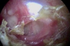 Central perforation, moist margins, with dry crusts in canal, L ear.