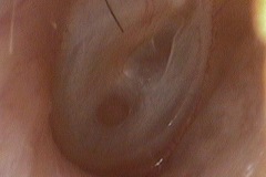Healed perforations, R ear