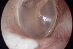 Normal R ear, ISJ just visibke through slightly thinner postero-superior area of TM
